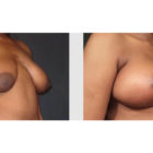 A Before and After photo of a Breast Lift Plastic Surgery by Dr. Craig Jonov in Bellevue, Kirkland, and Lynnwood.