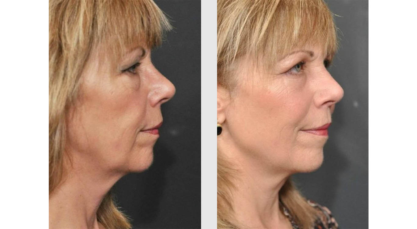 A Before and After photo of Filler injections at The Gallery of Cosmetic Surgery in Bellevue, Kirkland, and Lynnwood.
