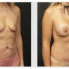 A Before and After photo of a Mommy Makeover Plastic Surgery by Dr. Craig Jonov in Bellevue, Kirkland, and Lynnwood.
