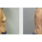 A Before and After photo of a Breast Augmentation Plastic Surgery by Dr. Craig Jonov in Bellevue, Kirkland, and Lynnwood.