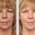 A Before and After photo of Filler injections at The Gallery of Cosmetic Surgery in Bellevue, Kirkland, and Lynnwood.