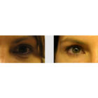 A Before and After photo of Filler injections at The Gallery of Cosmetic Surgery in Bellevue, Kirkland, and Lynnwood.