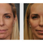 A Before and After photo of Filler injections at The Gallery of Cosmetic Surgery in Bellevue, Kirkland, and Lynnwood.