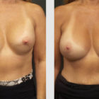 A Before and After photo of a Breast Augmentation Plastic Surgery by Dr. Craig Jonov in Bellevue, Kirkland, and Lynnwood.