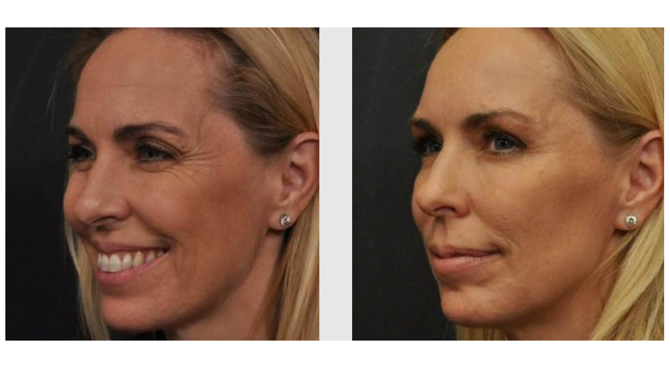 A Before and After photo of Filler injections at The Gallery of Cosmetic Surgery in Bellevue, Kirkland, and Lynnwood.