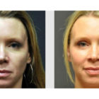 A Before and After photo of Filler injections at The Gallery of Cosmetic Surgery in Bellevue, Kirkland, and Lynnwood.