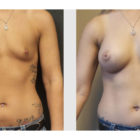 A Before and After photo of a Breast Augmentation Plastic Surgery by Dr. Craig Jonov in Bellevue, Kirkland, and Lynnwood.