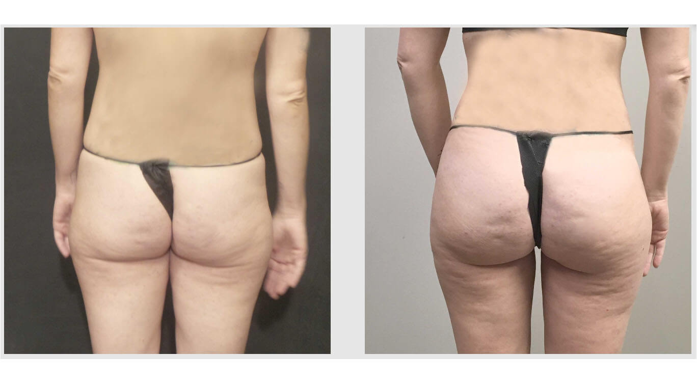 A Before and After photo of a Brazilian Butt Lift Plastic Surgery by Dr. Craig Jonov in Bellevue, Kirkland, and Lynnwood