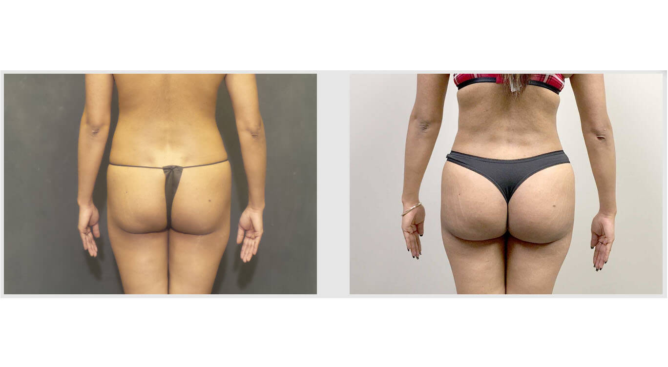 A Before and After photo of a Brazilian Butt Lift Plastic Surgery by Dr. Craig Jonov in Bellevue, Kirkland, and Lynnwood