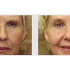 A Before and After photo of Filler injections at The Gallery of Cosmetic Surgery in Bellevue, Kirkland, and Lynnwood.