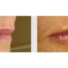 A Before and After photo of Filler injections at The Gallery of Cosmetic Surgery in Bellevue, Kirkland, and Lynnwood.