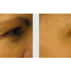 A Before and After photo of Filler injections at The Gallery of Cosmetic Surgery in Bellevue, Kirkland, and Lynnwood.