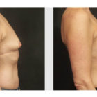 A Before and After photo of a Breast Augmentation Plastic Surgery by Dr. Craig Jonov in Bellevue, Kirkland, and Lynnwood.