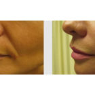 A Before and After photo of Filler injections at The Gallery of Cosmetic Surgery in Bellevue, Kirkland, and Lynnwood.