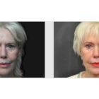 A Before and After photo of Filler injections at The Gallery of Cosmetic Surgery in Bellevue, Kirkland, and Lynnwood.