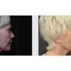 A Before and After photo of Filler injections at The Gallery of Cosmetic Surgery in Bellevue, Kirkland, and Lynnwood.