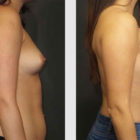 A Before and After photo of a Breast Augmentation Plastic Surgery by Dr. Craig Jonov in Bellevue, Kirkland, and Lynnwood.