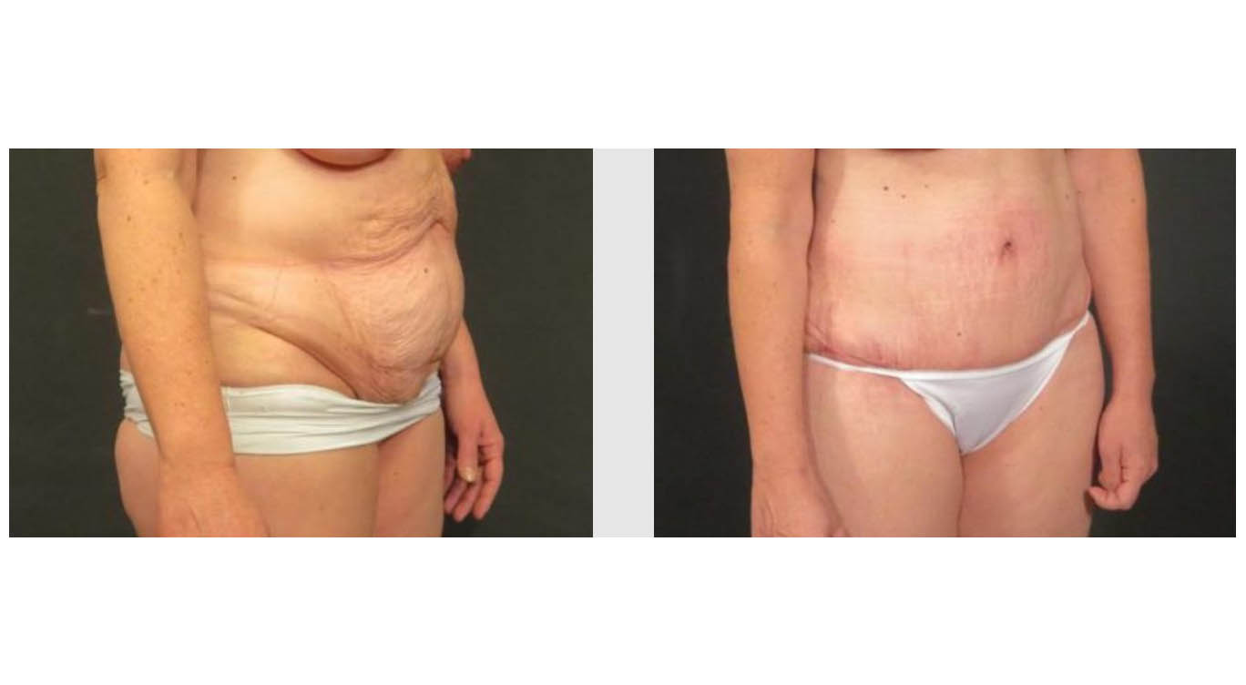 A Before & After Photo of a Tummy Tuck by Dr. Craig Jonov in Bellevue and Kirkland