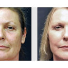 A Before and After photo of Filler injections at The Gallery of Cosmetic Surgery in Bellevue, Kirkland, and Lynnwood.