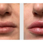 A Before and After photo of Filler injections at The Gallery of Cosmetic Surgery in Bellevue, Kirkland, and Lynnwood.