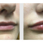 A Before and After photo of Filler injections at The Gallery of Cosmetic Surgery in Bellevue, Kirkland, and Lynnwood.