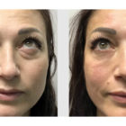 A Before and After photo of Filler injections at The Gallery of Cosmetic Surgery in Bellevue, Kirkland, and Lynnwood.