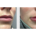 A Before and After photo of Filler injections at The Gallery of Cosmetic Surgery in Bellevue, Kirkland, and Lynnwood.