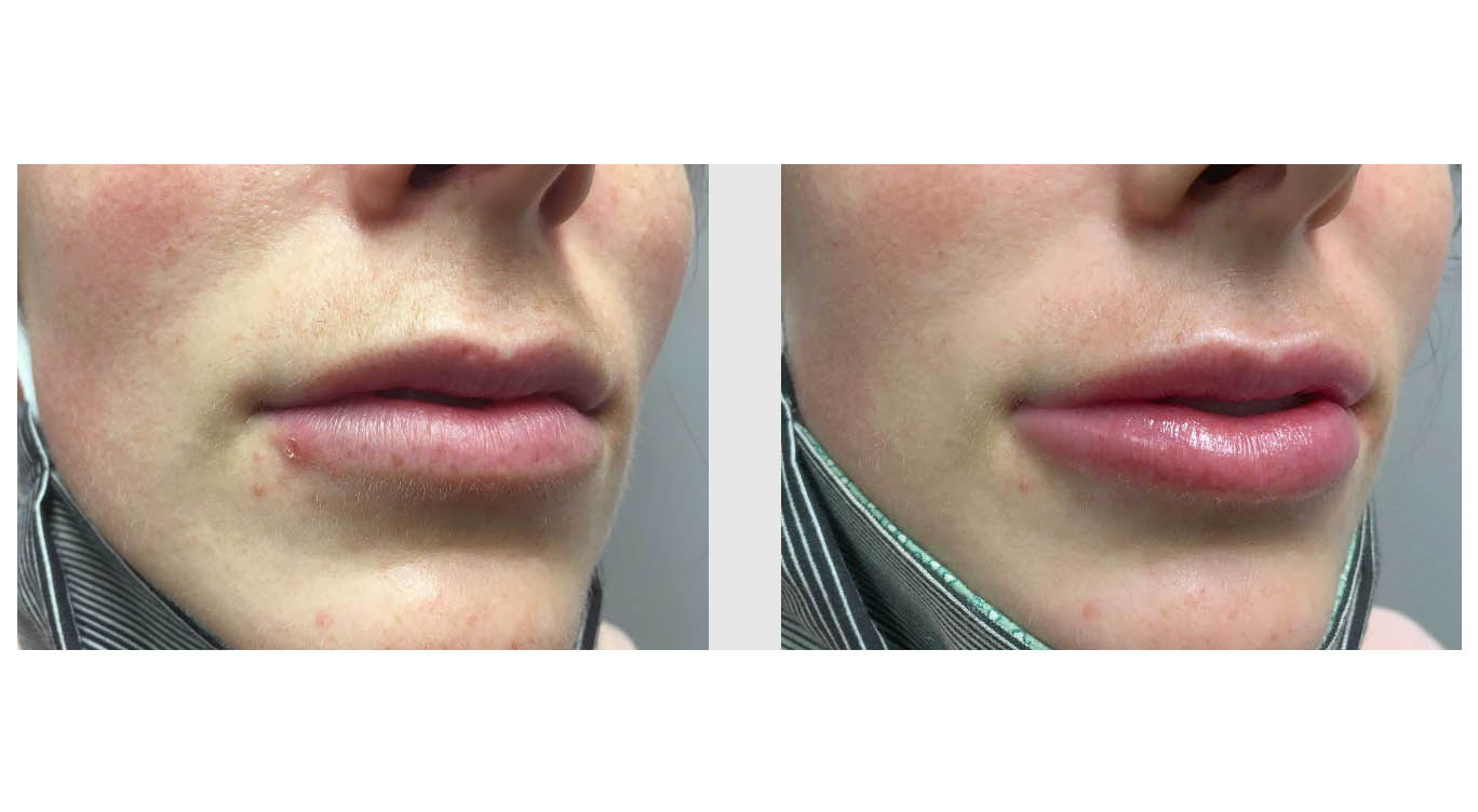 Patient Case #Injectable Fillers Case 12