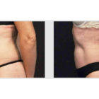 A Before and After photo of a Tummy Tuck Plastic Surgery by Dr. Craig Jonov in Bellevue, Kirkland, and Lynnwood.