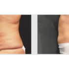 A Before and After photo of a Tummy Tuck Plastic Surgery by Dr. Craig Jonov in Bellevue, Kirkland, and Lynnwood.