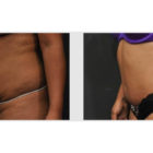 A Before and After photo of a Tummy Tuck Plastic Surgery by Dr. Craig Jonov in Bellevue, Kirkland, and Lynnwood.