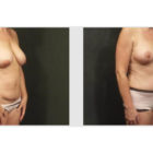A Before and After photo of a Tummy Tuck Plastic Surgery by Dr. Craig Jonov in Bellevue, Kirkland, and Lynnwood.