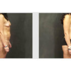 A Before and After photo of a Tummy Tuck Plastic Surgery by Dr. Craig Jonov in Bellevue, Kirkland, and Lynnwood.