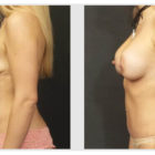 A Before and After photo of a Tummy Tuck Plastic Surgery by Dr. Craig Jonov in Bellevue, Kirkland, and Lynnwood.