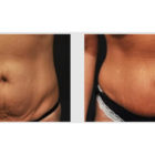 A Before and After photo of a Tummy Tuck Plastic Surgery by Dr. Craig Jonov in Bellevue, Kirkland, and Lynnwood.