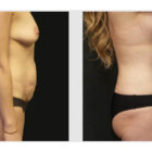 A Before and After photo of a Tummy Tuck Plastic Surgery by Dr. Craig Jonov in Bellevue, Kirkland, and Lynnwood.