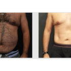 A Before and After photo of a Tummy Tuck Plastic Surgery by Dr. Craig Jonov in Bellevue, Kirkland, and Lynnwood.