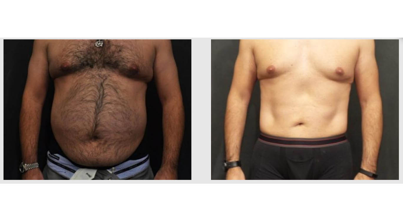 A Before and After photo of a Tummy Tuck Plastic Surgery by Dr. Craig Jonov in Bellevue, Kirkland, and Lynnwood.
