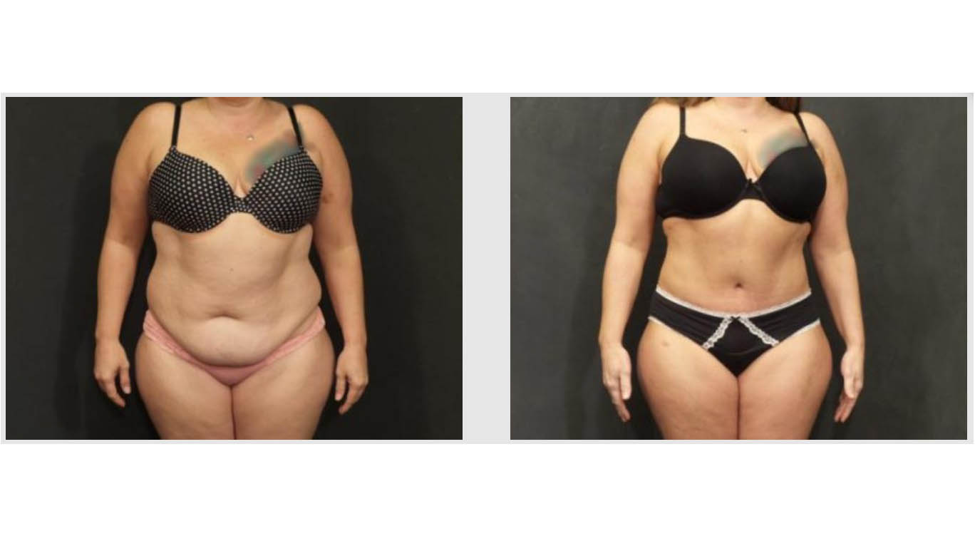 A Before and After photo of a Tummy Tuck Plastic Surgery by Dr. Craig Jonov in Bellevue, Kirkland, and Lynnwood.