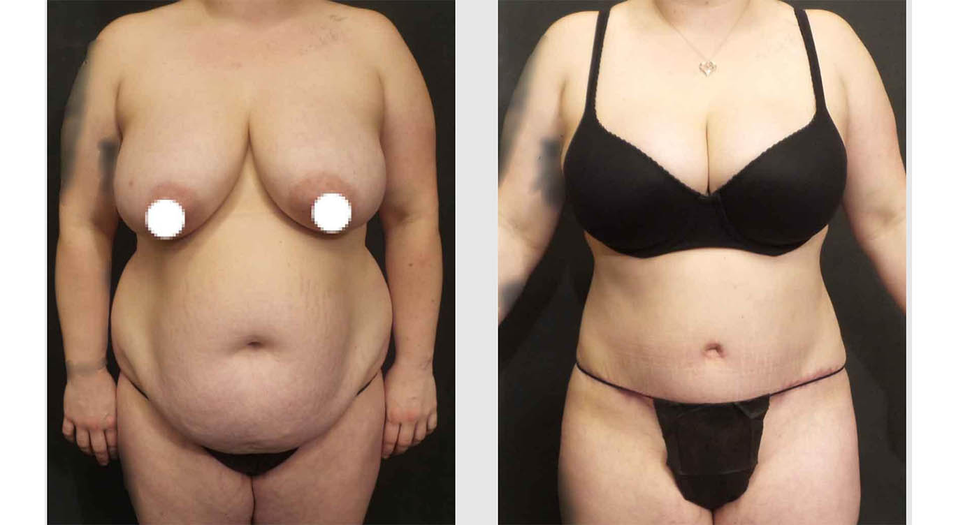 A Before and After photo of an Extended Tummy Tuck Plastic Surgery by Dr. Craig Jonov in Bellevue, Kirkland, and Lynnwood.