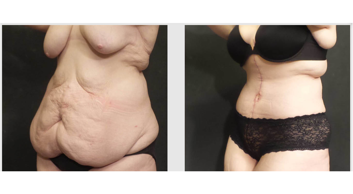 A Before and After photo of a Tummy Tuck Plastic Surgery by Dr. Craig Jonov in Bellevue, Kirkland, and Lynnwood.