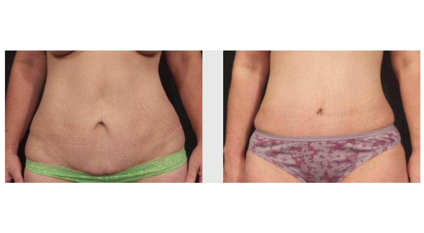 A Before and After photo of a Tummy Tuck Plastic Surgery by Dr. Craig Jonov in Bellevue, Kirkland, and Lynnwood.