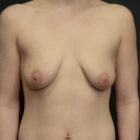 A Before and After photo of a Breast Augmentation Plastic Surgery by Dr. Craig Jonov in Bellevue, Kirkland, and Lynnwood.
