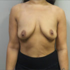 A Before and After photo of a Breast Augmentation With Lift Plastic Surgery by Dr. Craig Jonov in Bellevue, Kirkland, and Lynnwood.