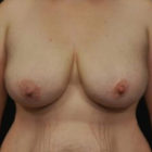 A Before and After photo of a Breast Lift Plastic Surgery by Dr. Craig Jonov in Bellevue, Kirkland, and Lynnwood.