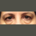 A Before and After photo of an Eyelid Lift Plastic Surgery by Dr. Craig Jonov in Bellevue, Kirkland, and Lynnwood.