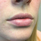 A Before and After photo of Filler injections at The Gallery of Cosmetic Surgery in Bellevue, Kirkland, and Lynnwood.