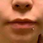 A Before and After photo of Juvederm Lip Filler at The Gallery of Cosmetic Surgery in Bellevue, Kirkland, and Lynnwood.