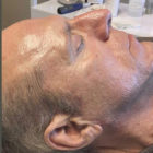 A Before and After photo of Microneedling by Master Estheticians at The Gallery of Cosmetic Surgery in Bellevue, Kirkland, and Lynnwood.