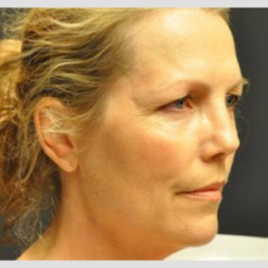 Neck Lift Before and After Case 07 | Seattle Plastic Surgery